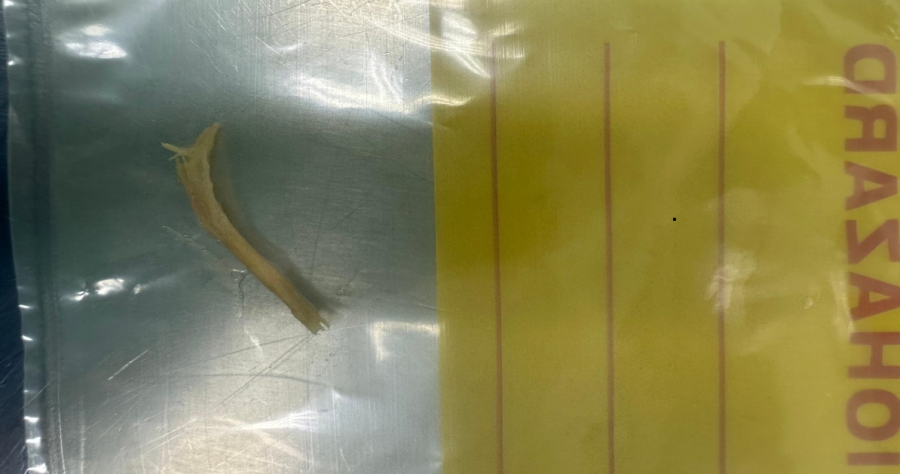 عود أسنان يهدد حياة امرأة