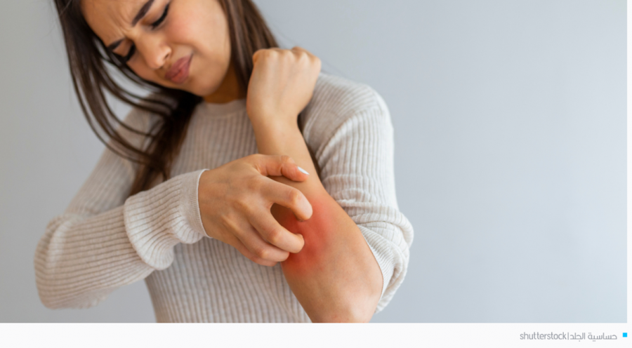 5 أعشاب تساعد على التقليل من أعراض حساسية الجلد